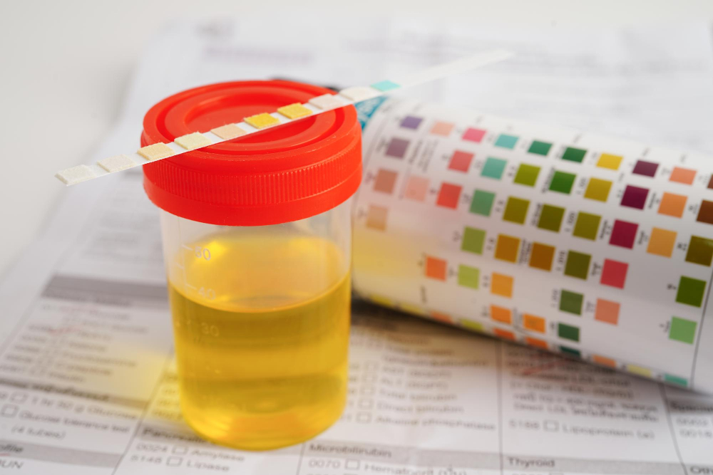 How To Interpret Quantitative Urinalysis Results In Clinical Practice