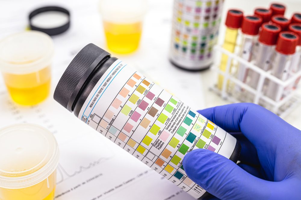 vial-urinalysis-test-strip-used-ketosis-control-other-9-parameters-such-asleukocytes-urobilinogen-bilirubin-blood-nitrite-ph-density-protein-glucose-ketone-bodies-ketosis